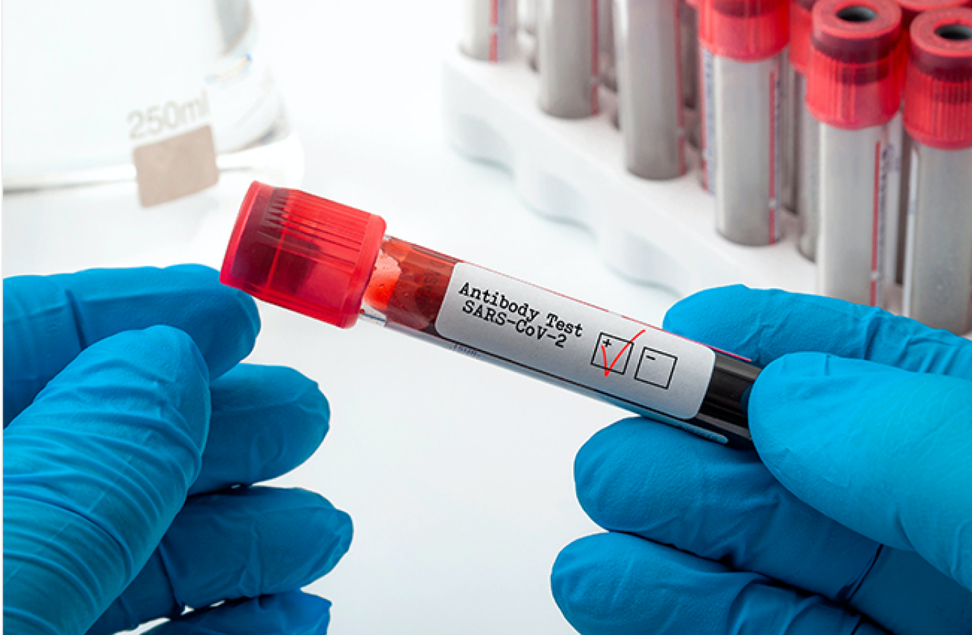 COVID-19 antibody testing
